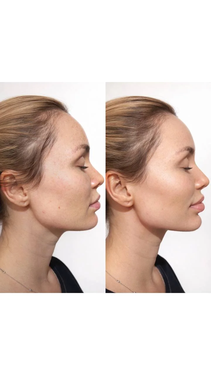 Губы и ботокс на Бали